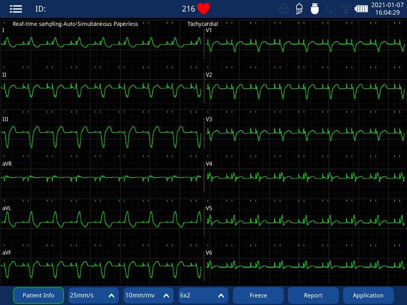 pace detection ECG machine(002) pace detection ECG machine(002)